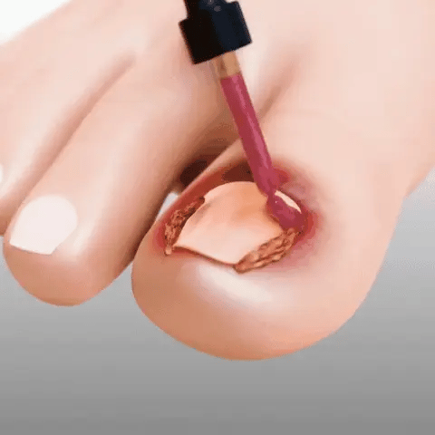 FungiClear™ – Nagelherstelserum